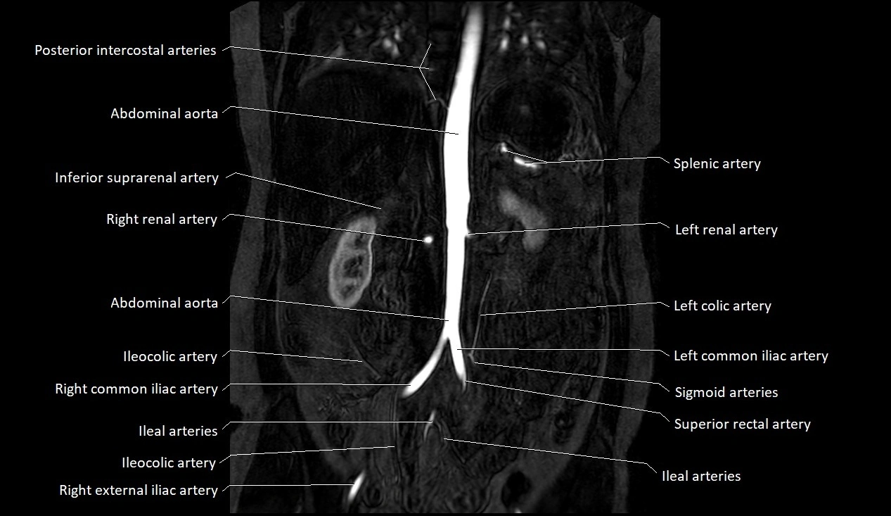 MRA Abdomen coronal anatomy image 22.webp